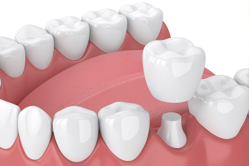 Dental Crowns in Highland