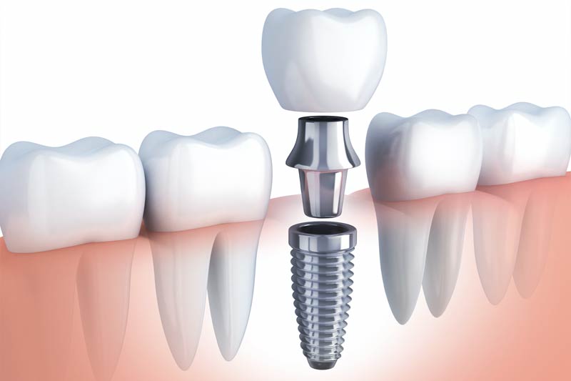 Implants Dentist in Highland