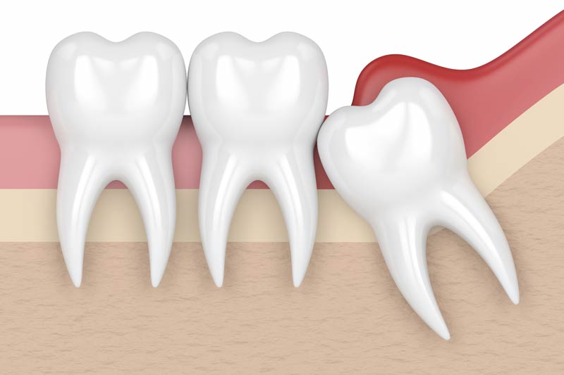 Wisdom Tooth Removal in Highland